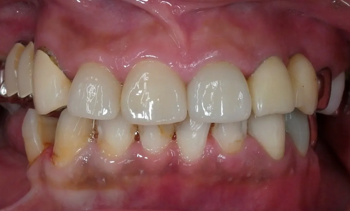 ハイグレードのジルコニアクラウン（被せ物）を装着し、審美回復を行いました。