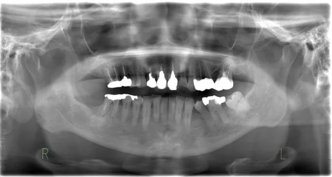 抜歯と嚢胞摘出手術を行い、術後問題なく経過しています。