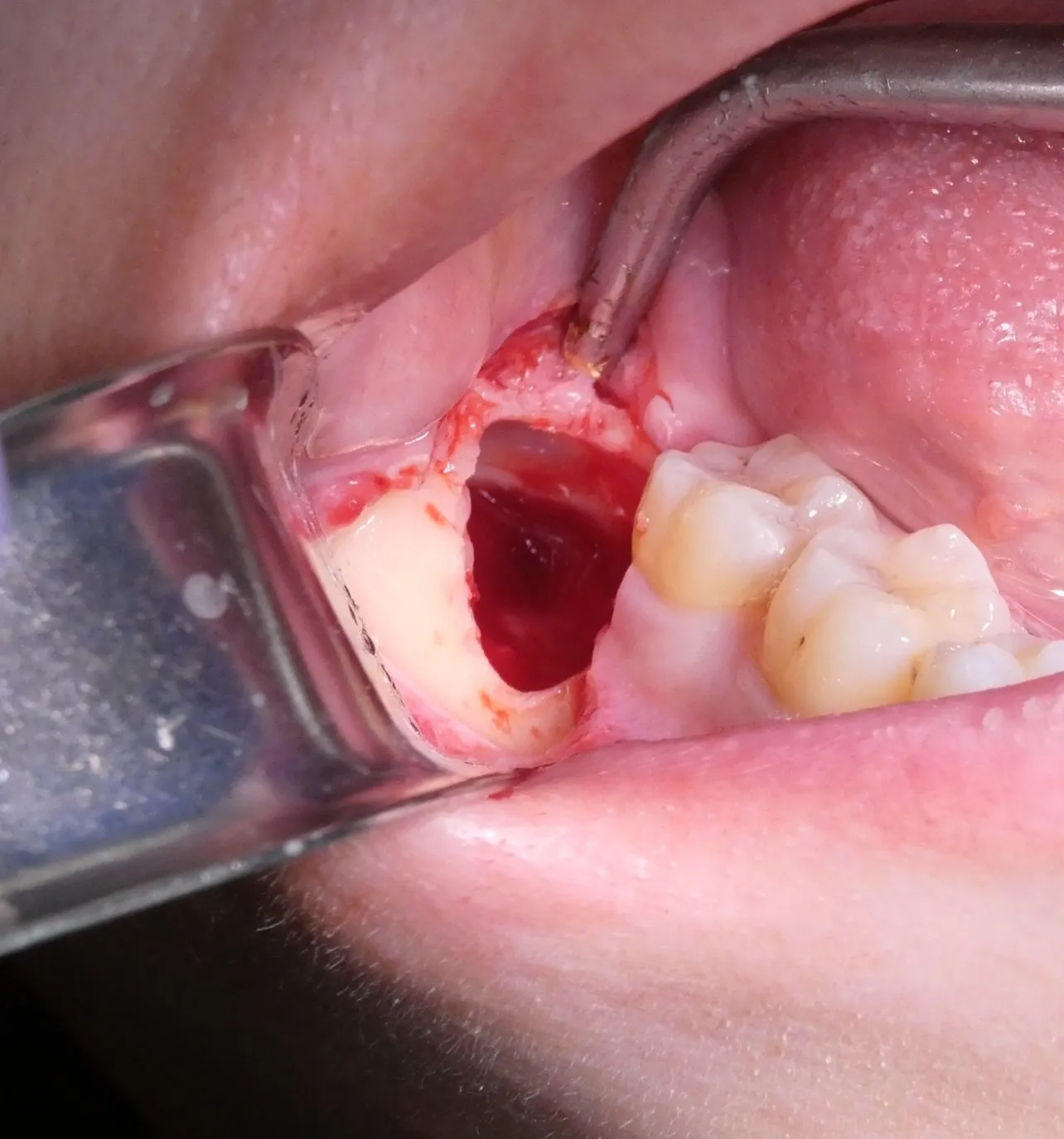 智歯を抜去した後、周囲の骨をきれいに整えました。