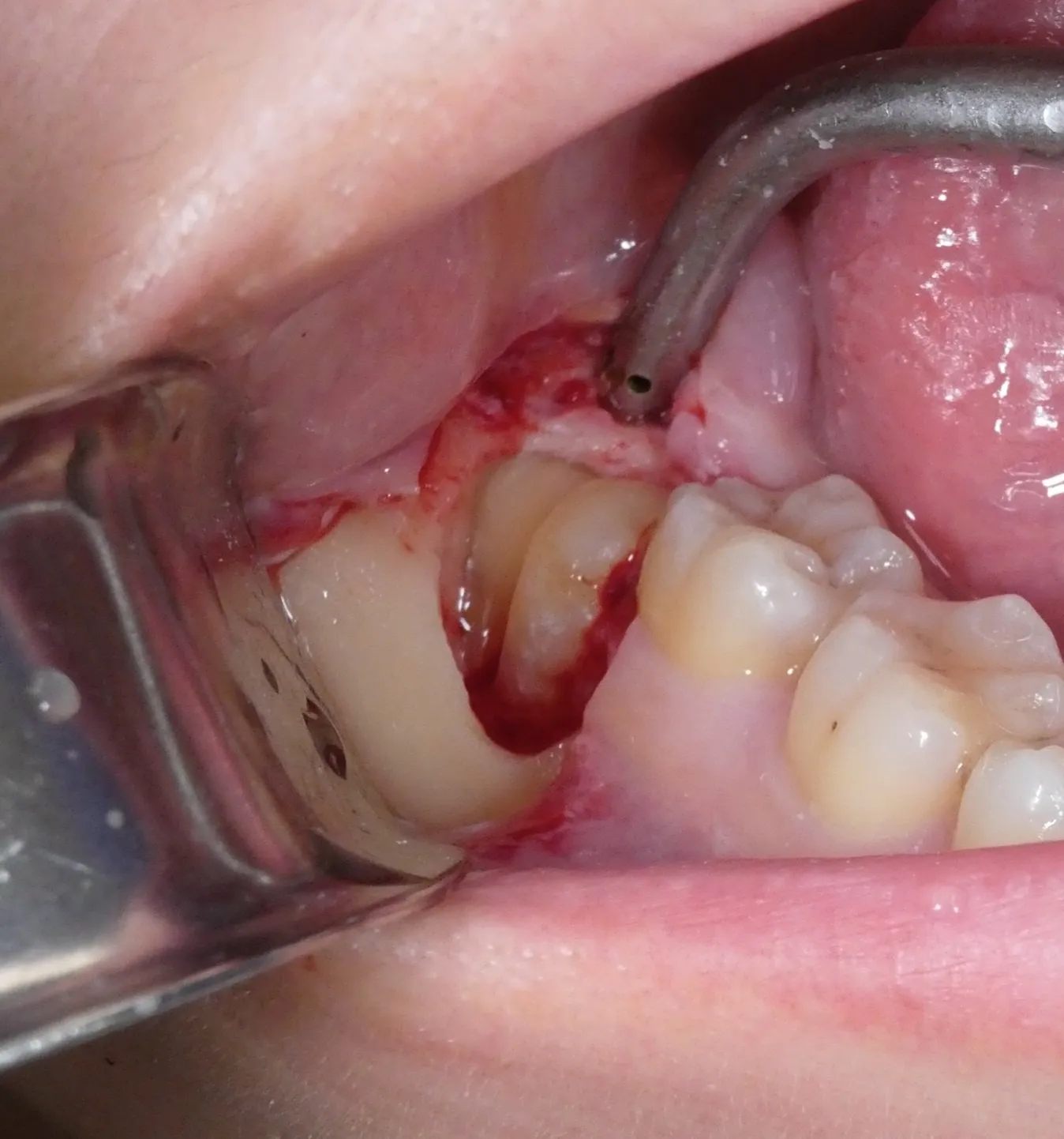 抜歯をするために、切開・剥離をし、智歯を分割しました（術中）。