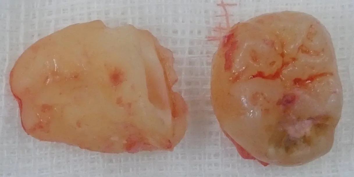 分割抜去した智歯です。