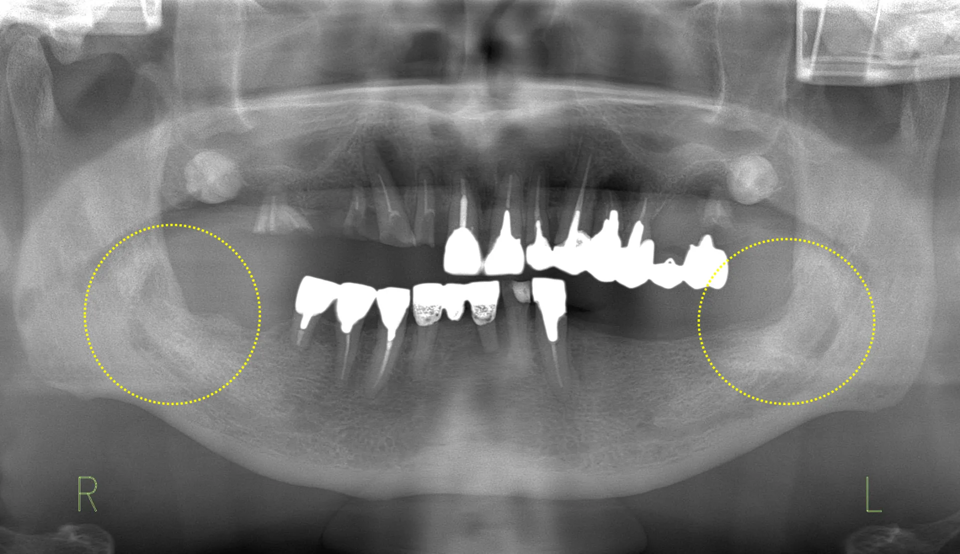 抜歯と嚢胞摘出手術を行い、約１年経過後。きれいに骨ができています。
