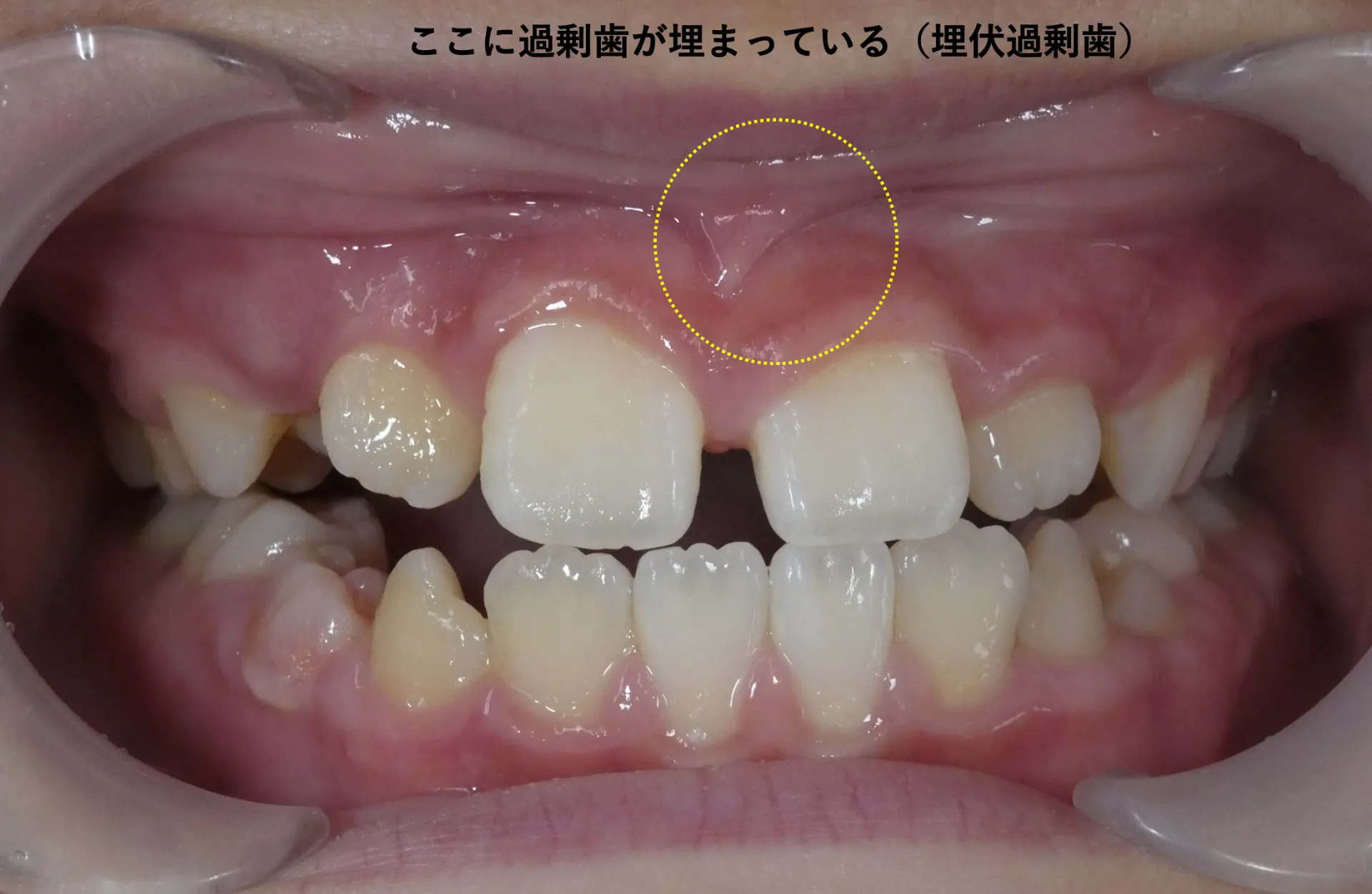 過剰歯の影響で歯並びの不正が認められるため、抜歯手術を行いました。