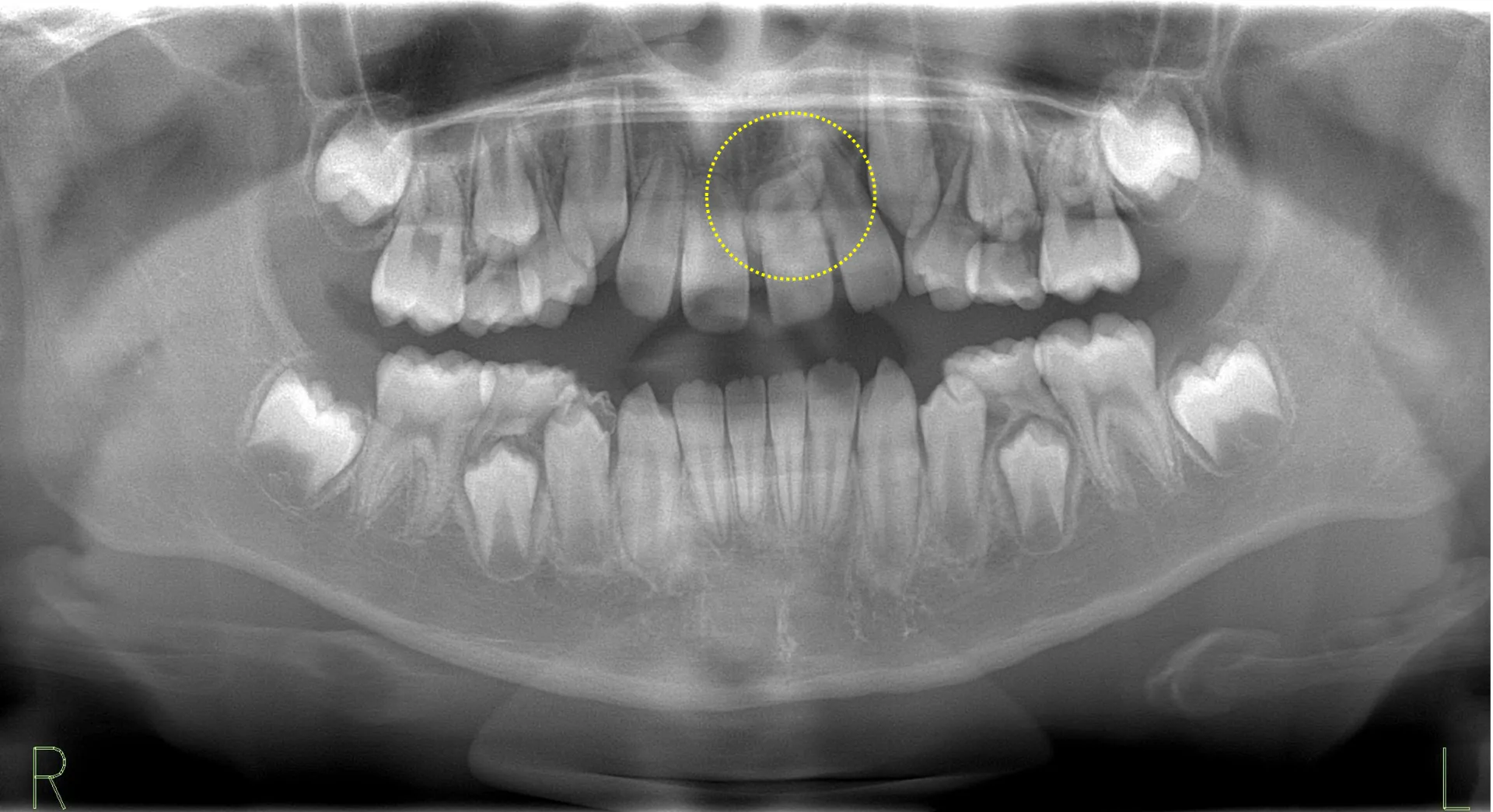 正中埋伏過剰歯