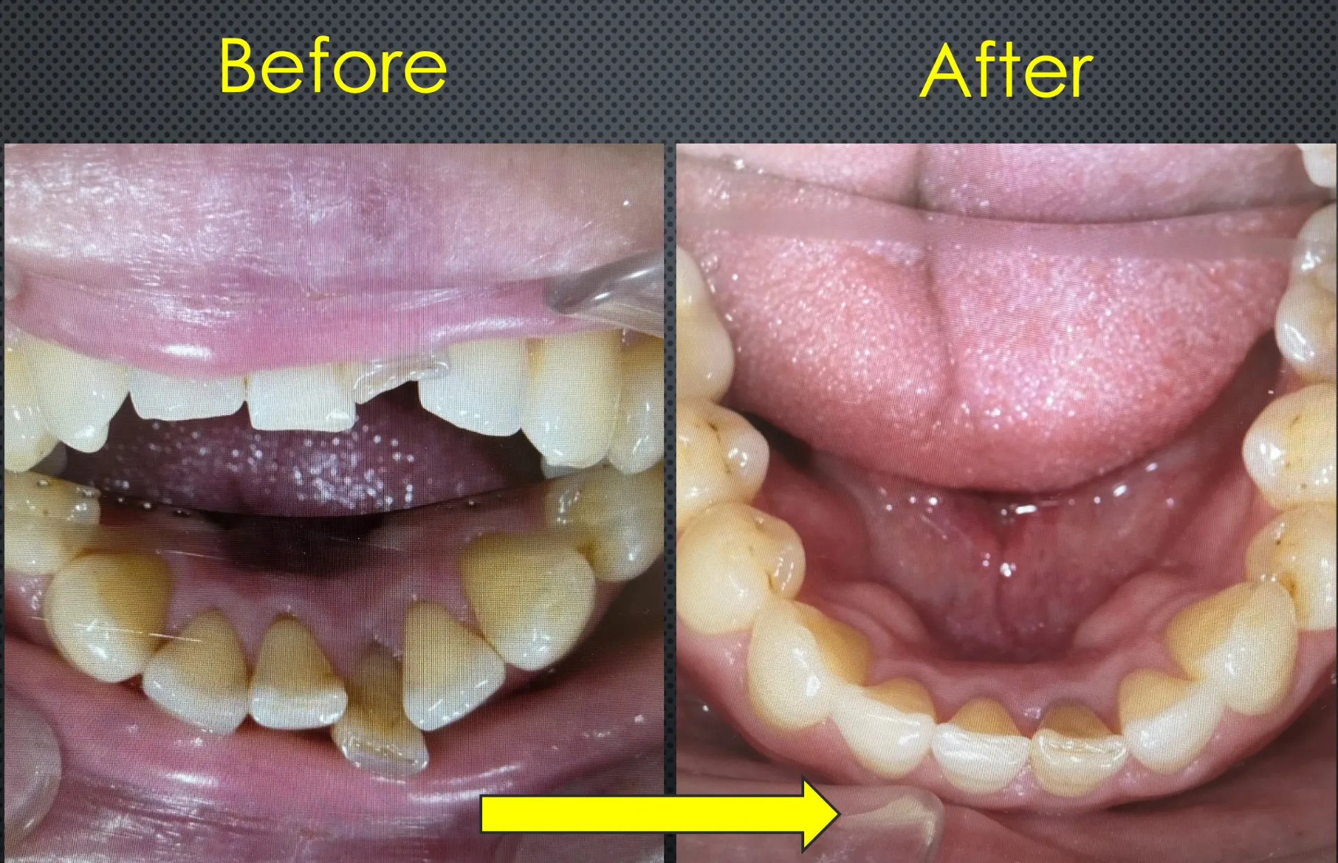 下顎の前歯の「歯ならびと咬み合わせ」がキレイになりました。