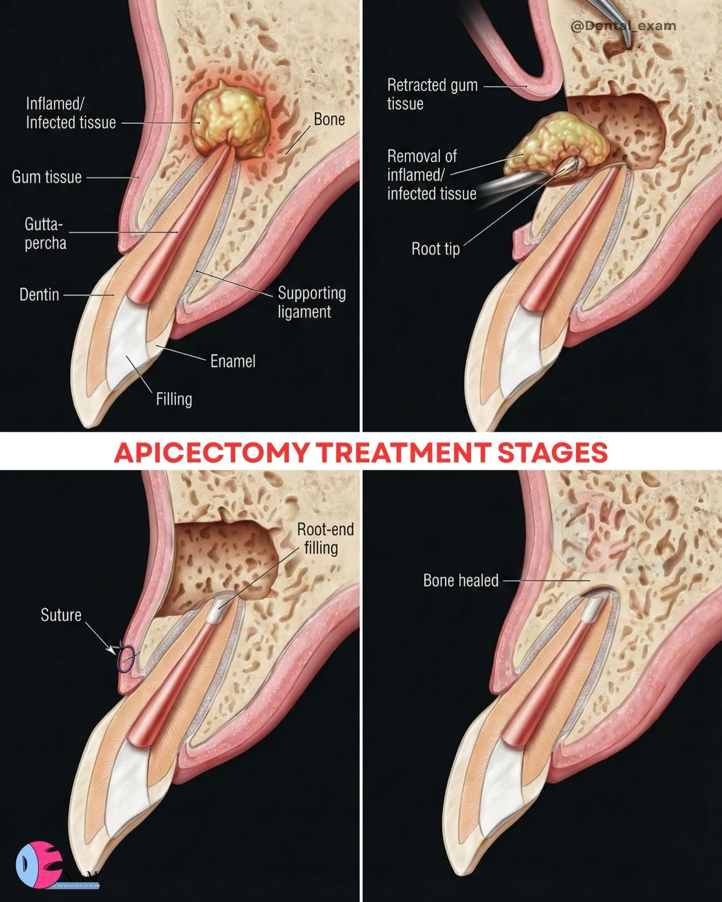 🦷口腔外科小手術🦷