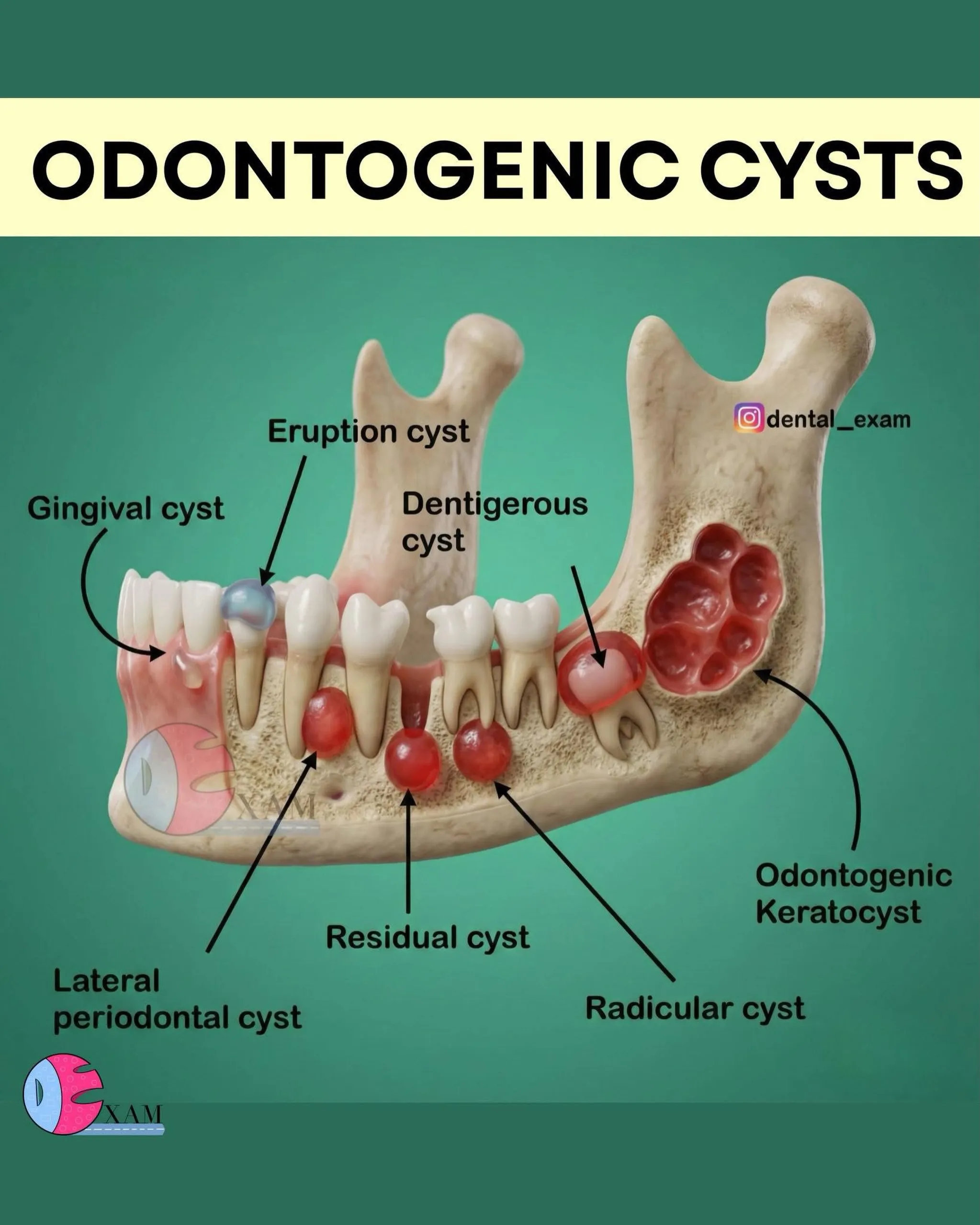 顎の骨の中に発生する様々な嚢胞（Cyst＝膿の袋）🦷