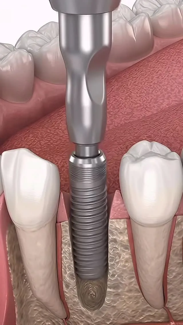 🦷インプラント手術🧑‍⚕️